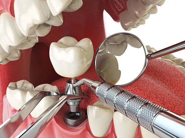 Best Emergency Dental Extractions in Sour Lake, TX
